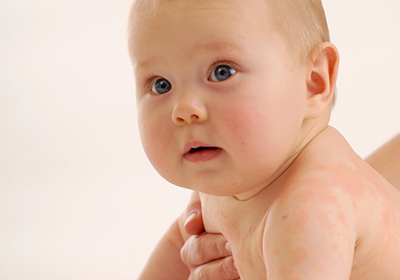 敏感的嬰兒肌膚